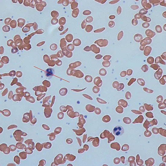 unstable hemoglobin